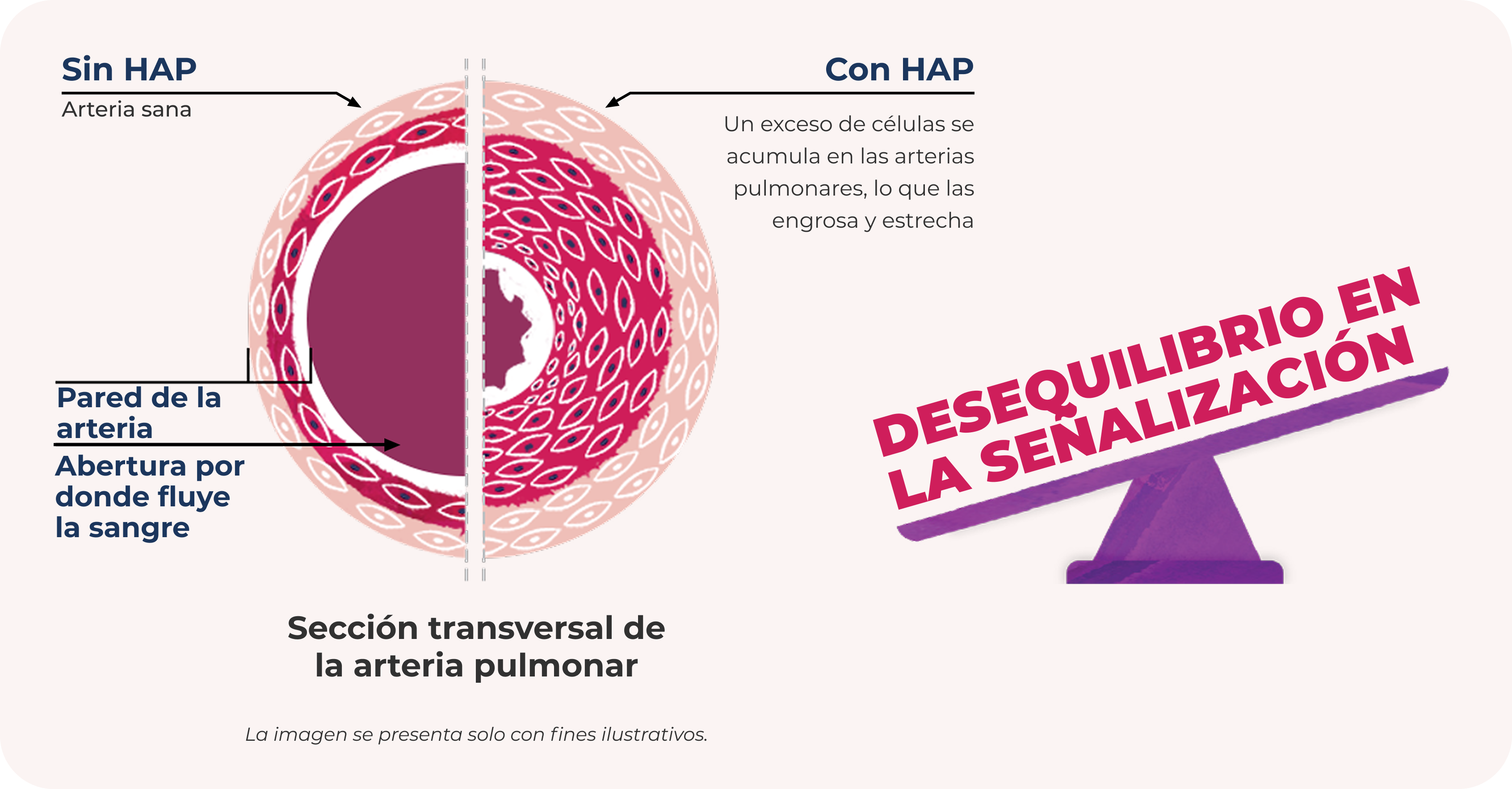Sección transversal de la arteria pulmonar: En los pacientes con HAP, las paredes de las arterias pulmonares se engrosan, lo que estrecha el espacio por donde puede fluir la sangre