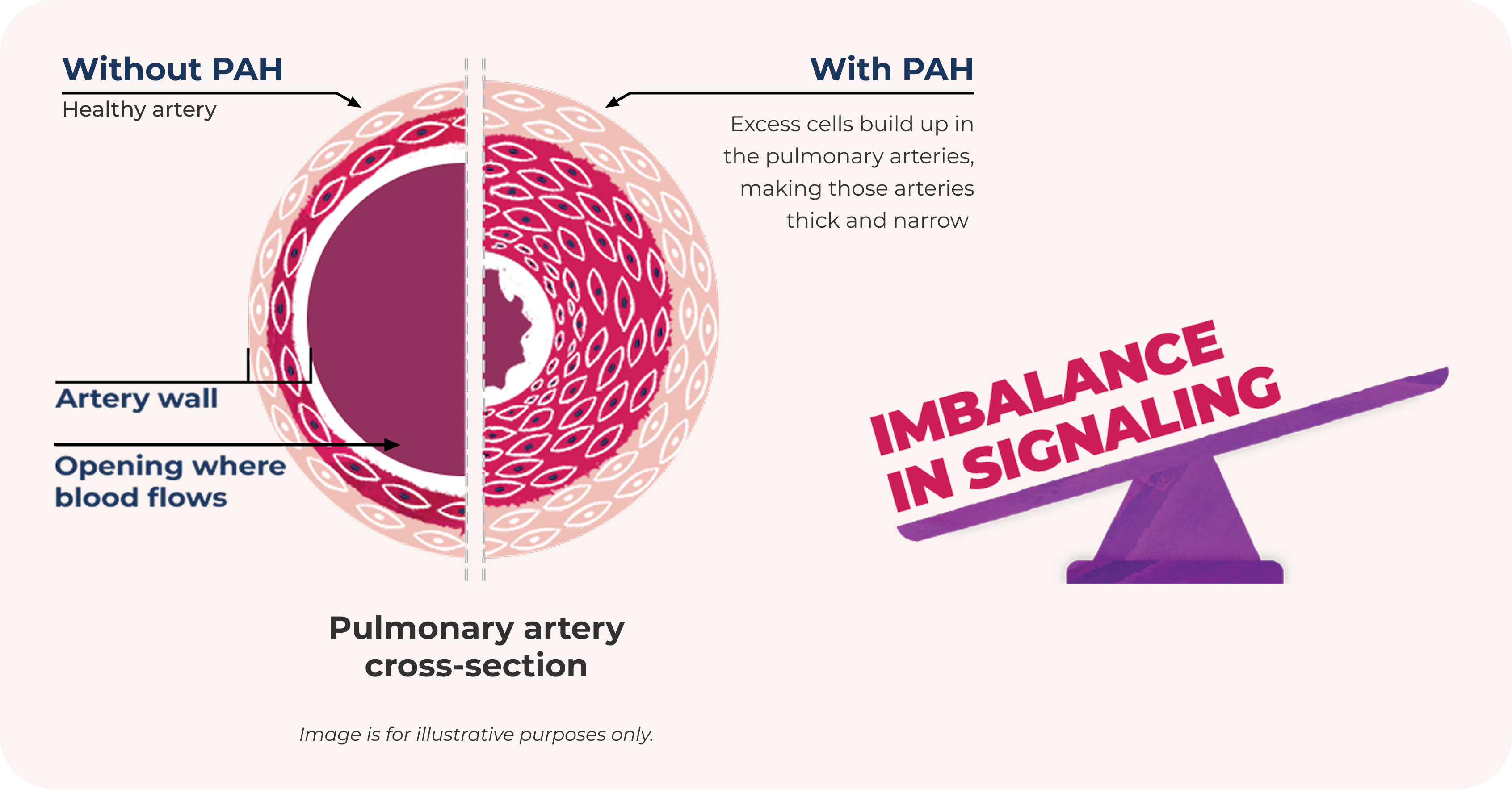 Pulmonary Artery Cross-section: In Patients With PAH, the Walls of the Pulmonary Arteries Thicken, Which Narrows the Space Where Blood Can Flow
